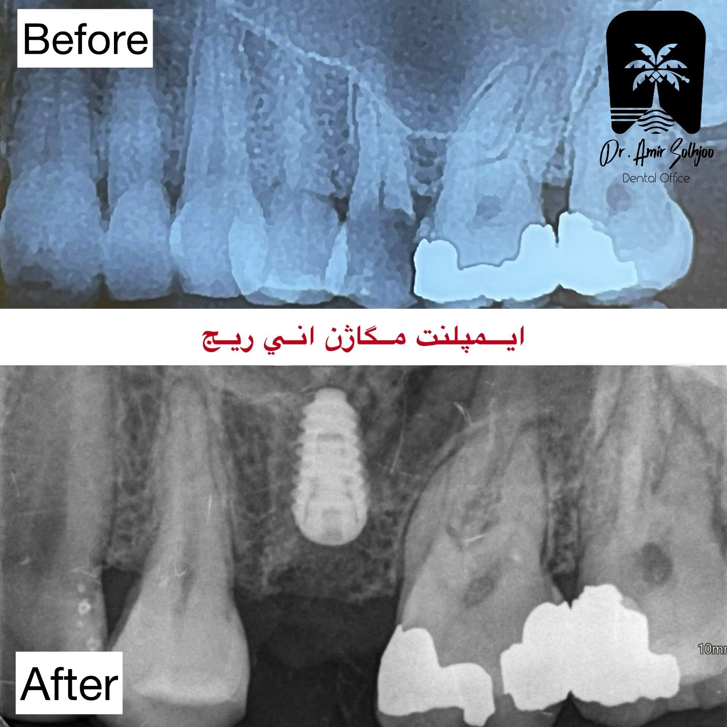 زرع AnyRidge Megagen: نظام Megagen المتقدم