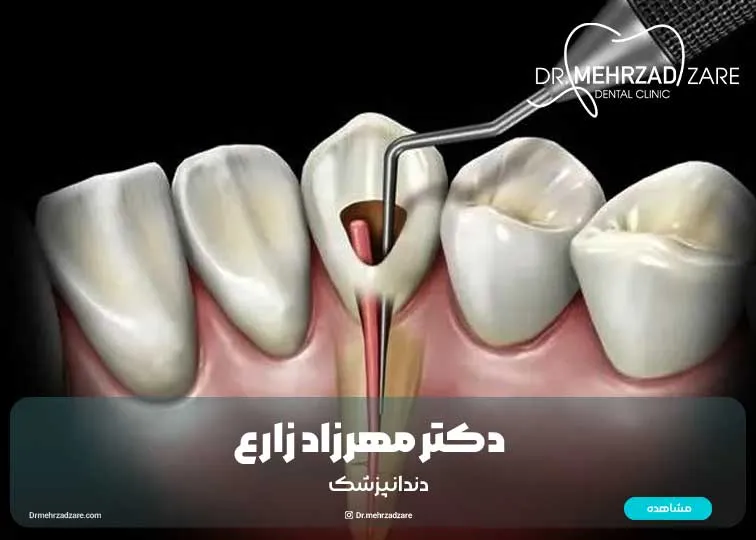 What is a tooth cavity? A complete guide to the prevention, treatment and care of tooth decay