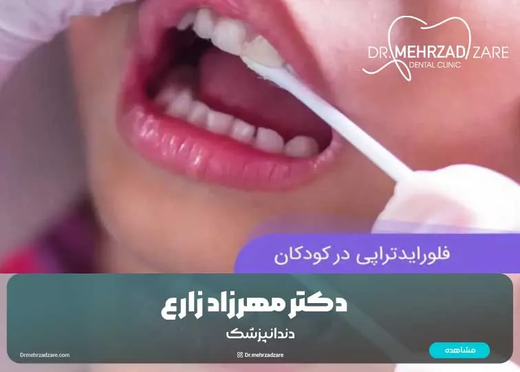 فلوراید برای کودکان: راهنمای کامل برای پیشگیری و مراقبت از دندان