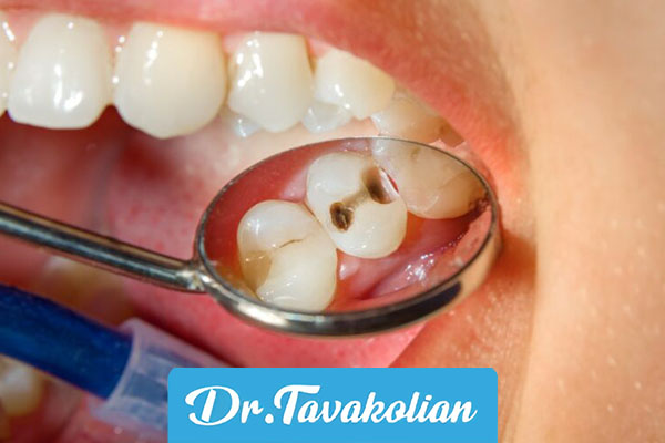 ترمیم دندان کودکان با مواد همرنگ - دکتر توکلیان