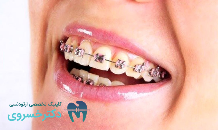 ارتودنسی زودرس چیست؟ حقایق و مزایا را بررسی کنید