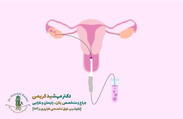 سوراخ کردن یا تخمک گذاری در IVF چگونه انجام می شود؟