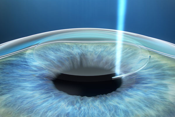 جراحی فمتولیز و برتری آن نسبت به سایر جراحی های چشم