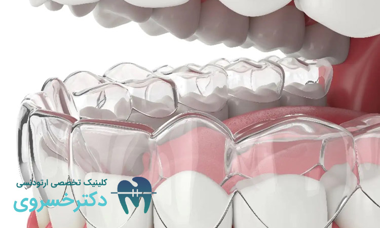 دندان هایی که نیاز به ارتودنسی نامرئی دارند؟