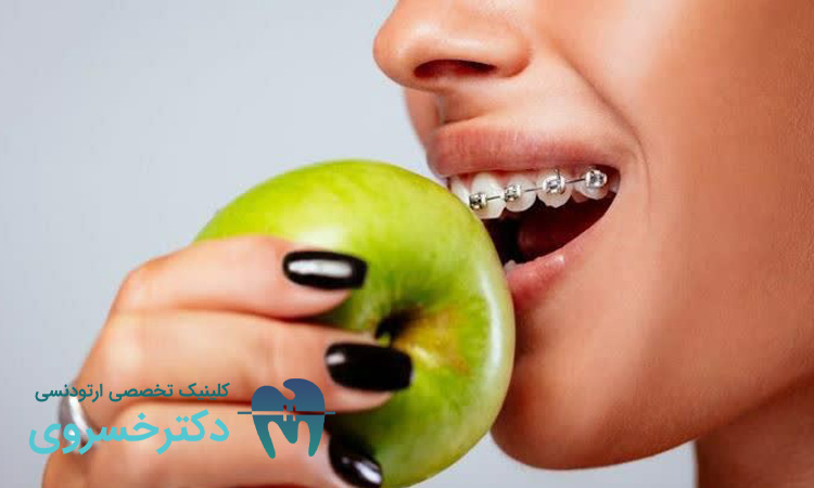 راهنمای تغذیه و تاثیر میکروبیوتای دهان بر روند درمان ارتودنسی - مطب تخصصی دندانپزشکی دکتر مهدیه خسروی