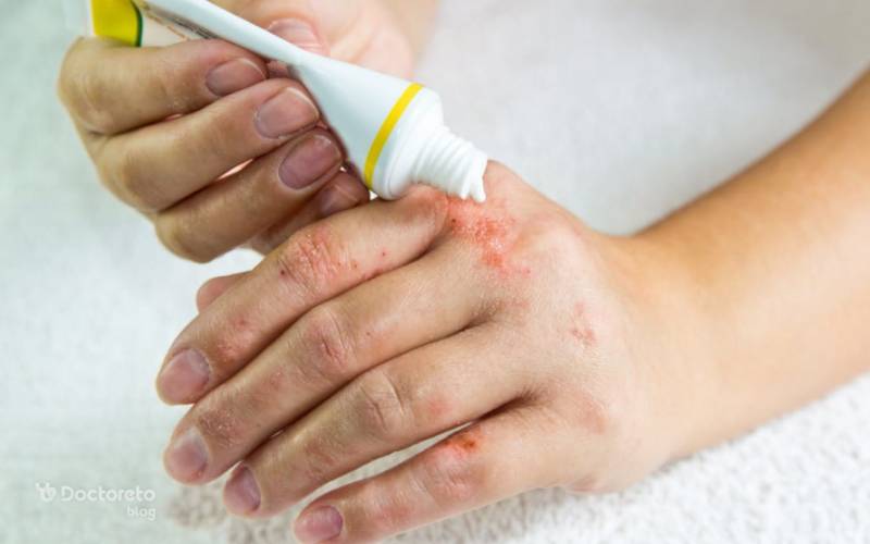 پماد کلوتریمازول چیست و چه کاربردی دارد؟