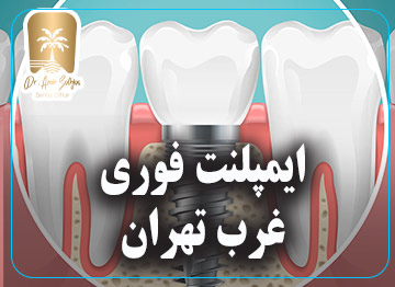 ایمپلنت فوری غرب تهران جدول هزینه + مشاوره تلفنی و حضوری رایگان