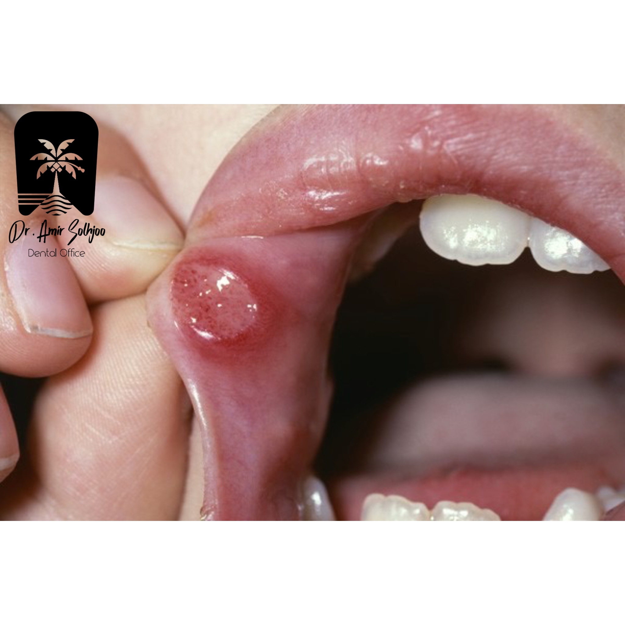 زخم دهان پس از شیمی درمانی بررسی علمی و درمان قطعی