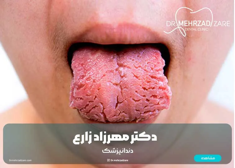 ترک خوردگی زبان: علل، علائم و درمان