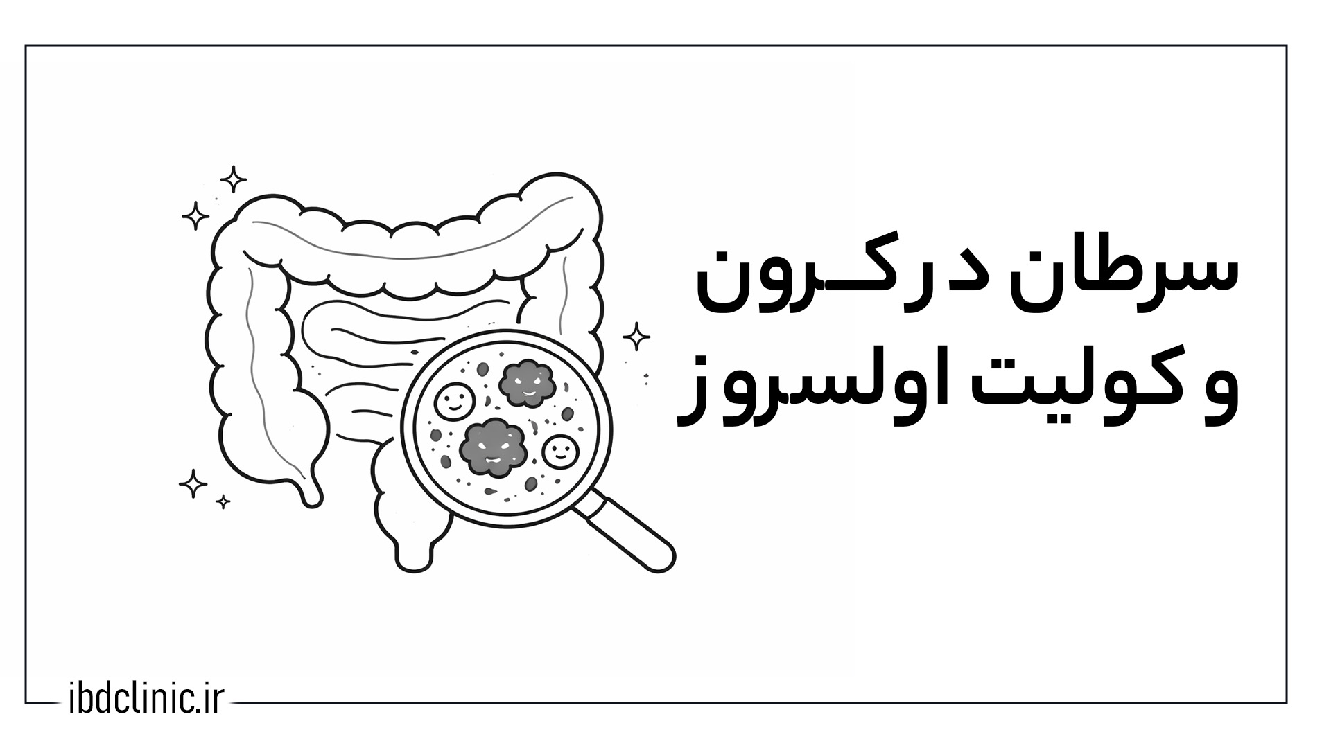 سرطان در کولیت کرون و اولسراتیو - کلینیک بیماری های التهابی روده