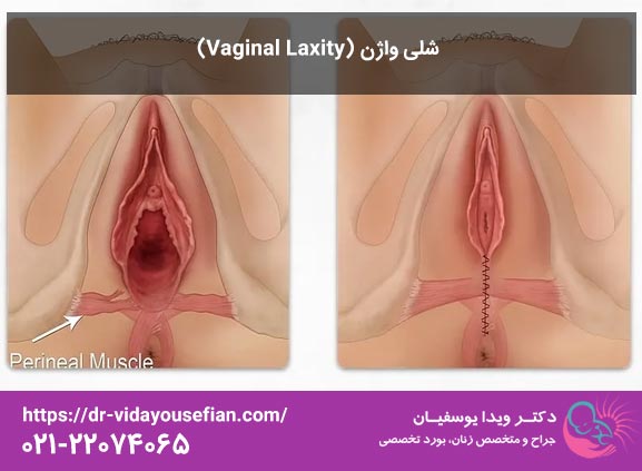 شلی واژن؛ علل، علائم و جدیدترین روش های درمان قطعی - دکتر ویدا یوسفیان