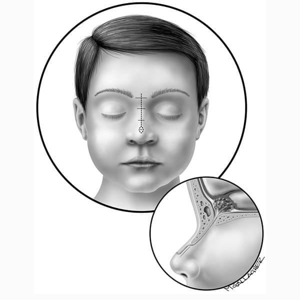 کیست بینی چیست؟ علائم و درمان - دکتر حمیدرضا راستی