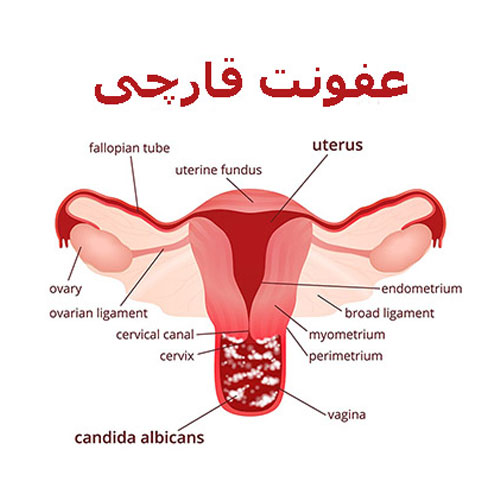 Fungal infection of the vagina