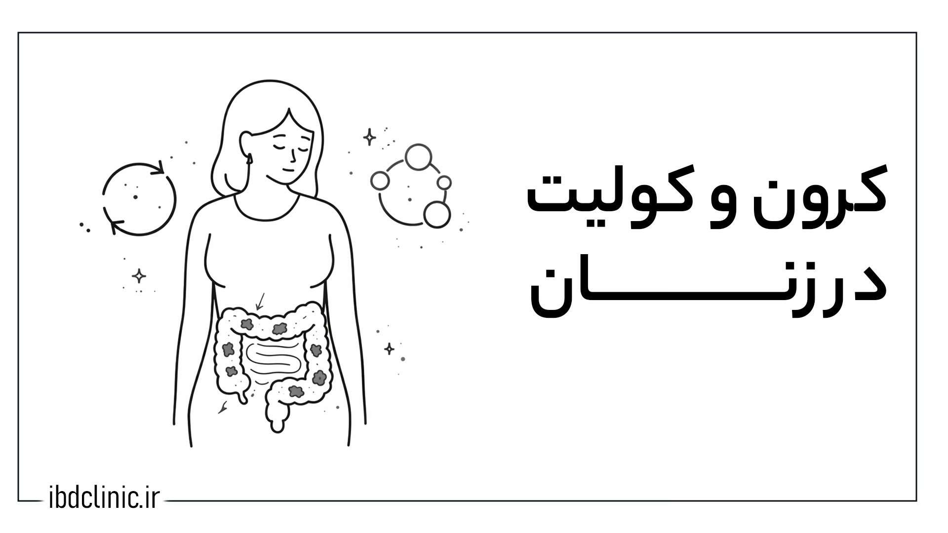کرون و کولیت در زنان - کلینیک بیماری های التهابی روده