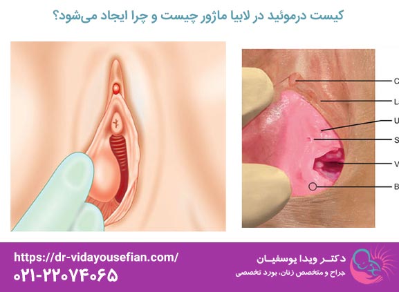 کیست درموئید در لابیا ماژور چیست و چرا ایجاد می شود؟ - دکتر ویدا یوسفیان