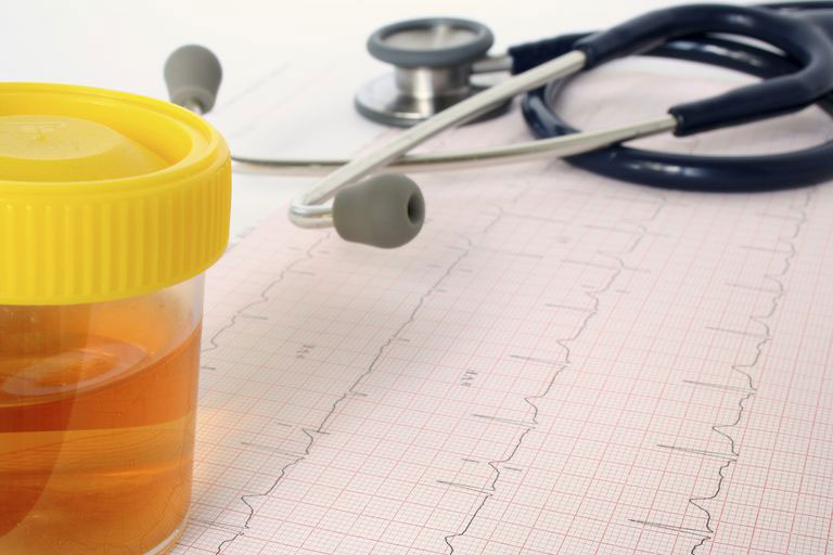 ادرار خونی (هماچوری) ، علل ، تشخیص و درمان آن چیست؟