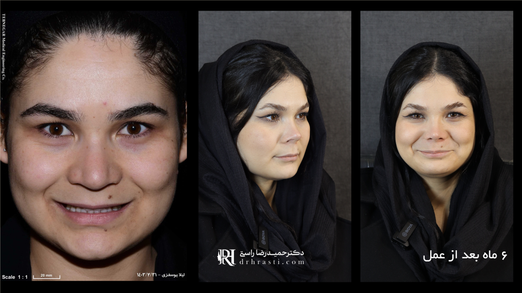 چند درصد از جراحی بینی بر زیبایی تاثیر می گذارد؟ - دکتر حمیدرضا راستی