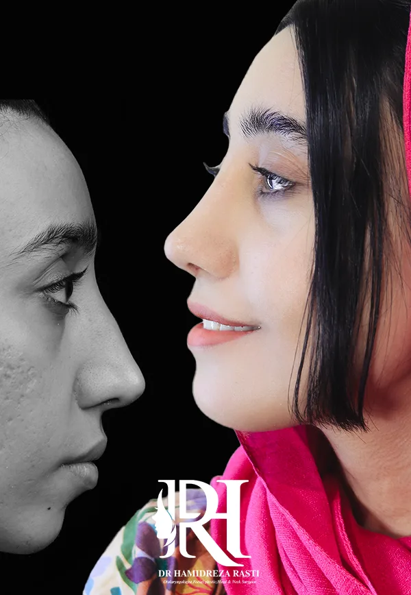 بهترین جراح بینی در تهران - دکتر حمیدرضا راستی