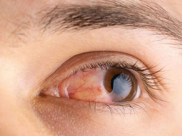 چه راهکارهایی برای درمان آلرژی چشم و حساسیت چشم مفید است؟ - دکتر احمدرضا خلیلیان