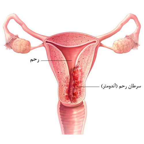 The cause of heavy bleeding during menstruation