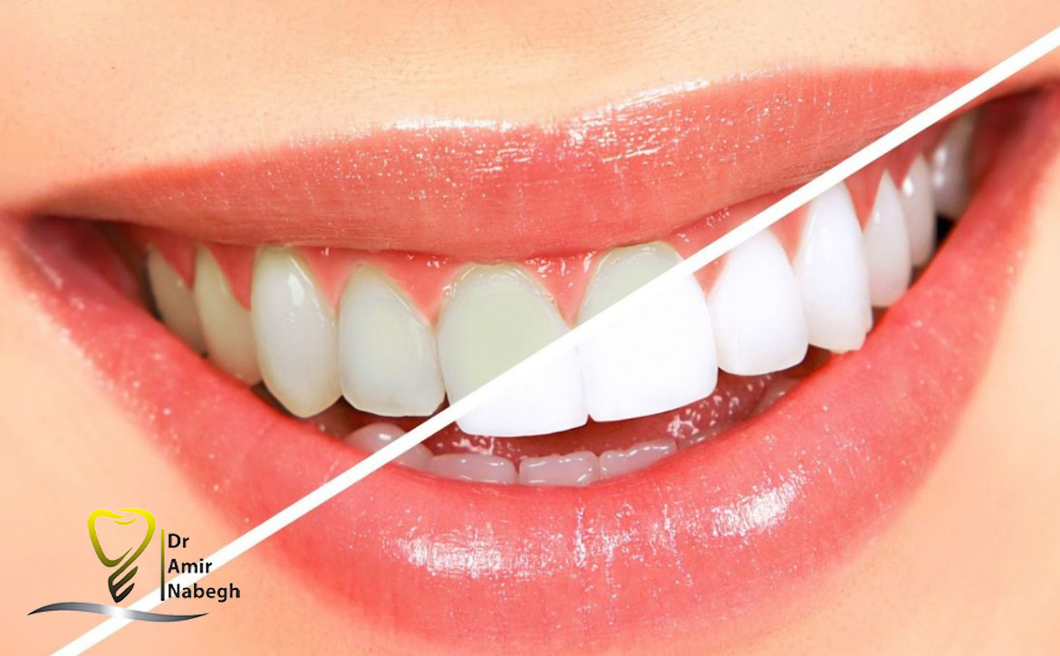 اصلاح رنگ و شکل دندان