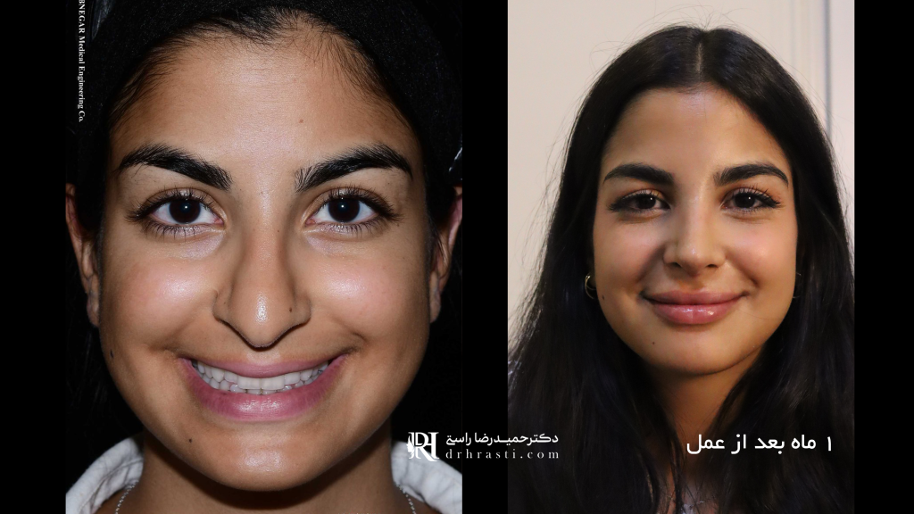 افتادگی نوک بینی: راهنمای کامل جراحی و درمان های غیر جراحی - دکتر حمیدرضا راستی