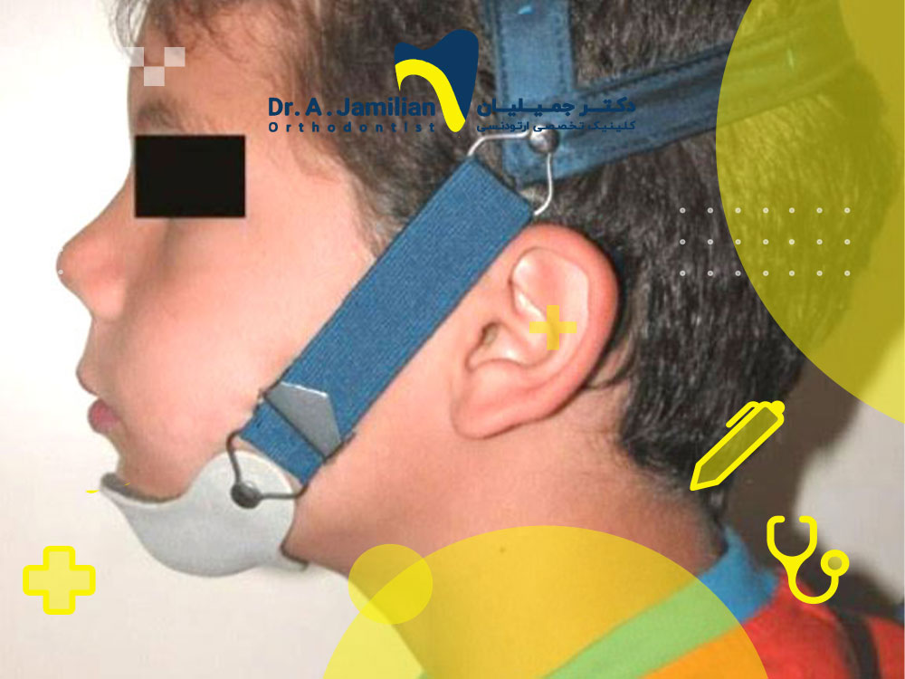 بند چانه ارتودنسی یا طبی + انواع، عملکرد و محدودیت های آن - دکتر جمیلیان