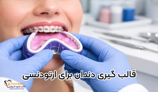 قالب گیری ارتودنسی چیست؟ | چقدر طول میکشه و چقدر درد داره؟