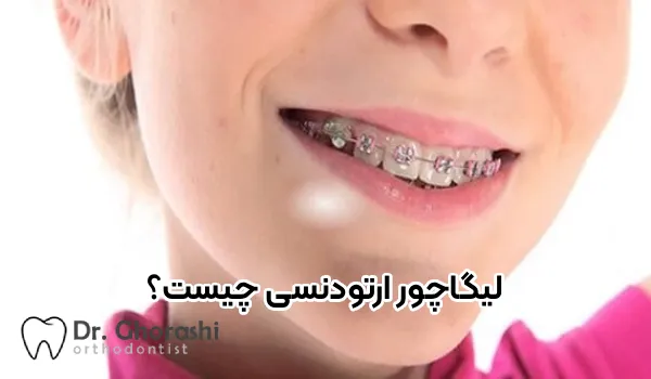 لیگاتور ارتودنسی چیست و چه کاربردی دارد؟