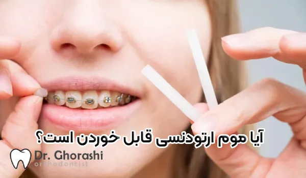 آیا موم ارتودنسی خوراکی است؟ | بررسی معایب و اقدامات لازم