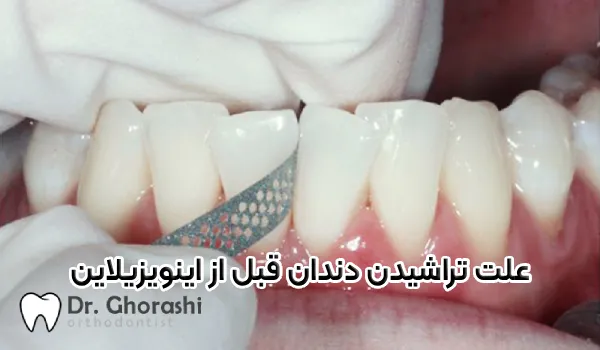 علت تراشیدن دندان قبل از اینویزیلاین چیست؟
