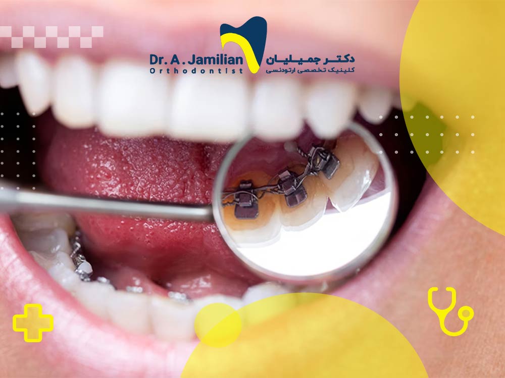 مراحل ارتودنسی لینگوال: از مشاوره اولیه تا برداشتن لوازم خانگی - دکتر جمیلیان