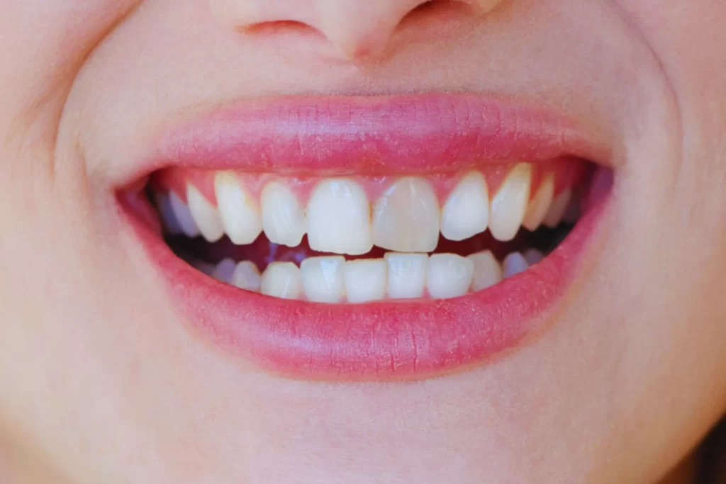 آیا کشیدن عصب باعث تیرگی دندان می شود؟ بررسی علمی علت تغییر رنگ پس از درمان ریشه - دکتر مجتبی جیرانی متخصص درمان ریشه