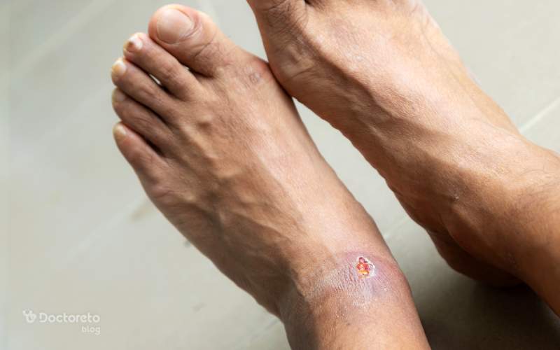 عفونت زخم پای دیابتی و نکات مهمی که باید در مورد آن بدانید