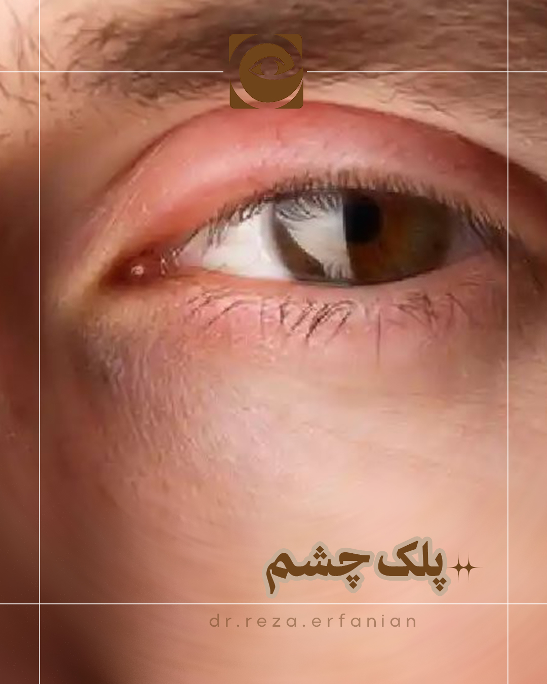 پلک چشم - نکات جالبی که درمورد پلک چشم انسان باید بدانید! - دکتر رضا عرفانیان سلیم