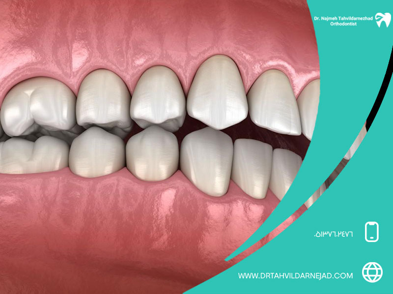 بررسی علل و روش های درمان اوربایت | دکتر