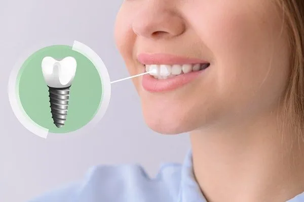 Is the implant lifelong? The facts you should know before tooth extraction - Dr. Mojtaba Jirani, an endodontic specialist
