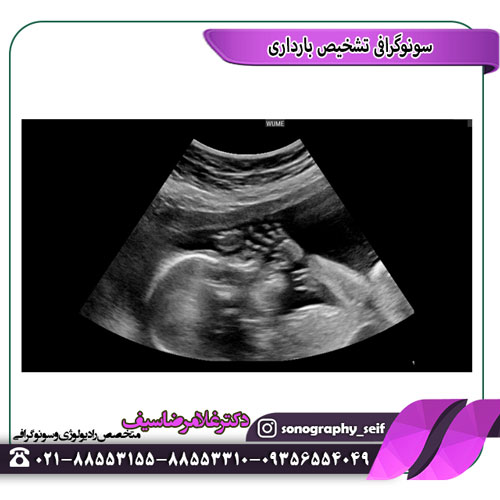 تشخیص سونوگرافی بارداری
