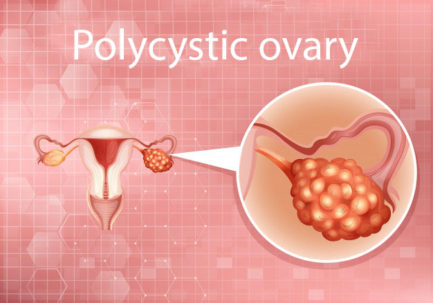4 راه برای درمان کیست تخمدان + فیلم - دکتر مریم غلامپور