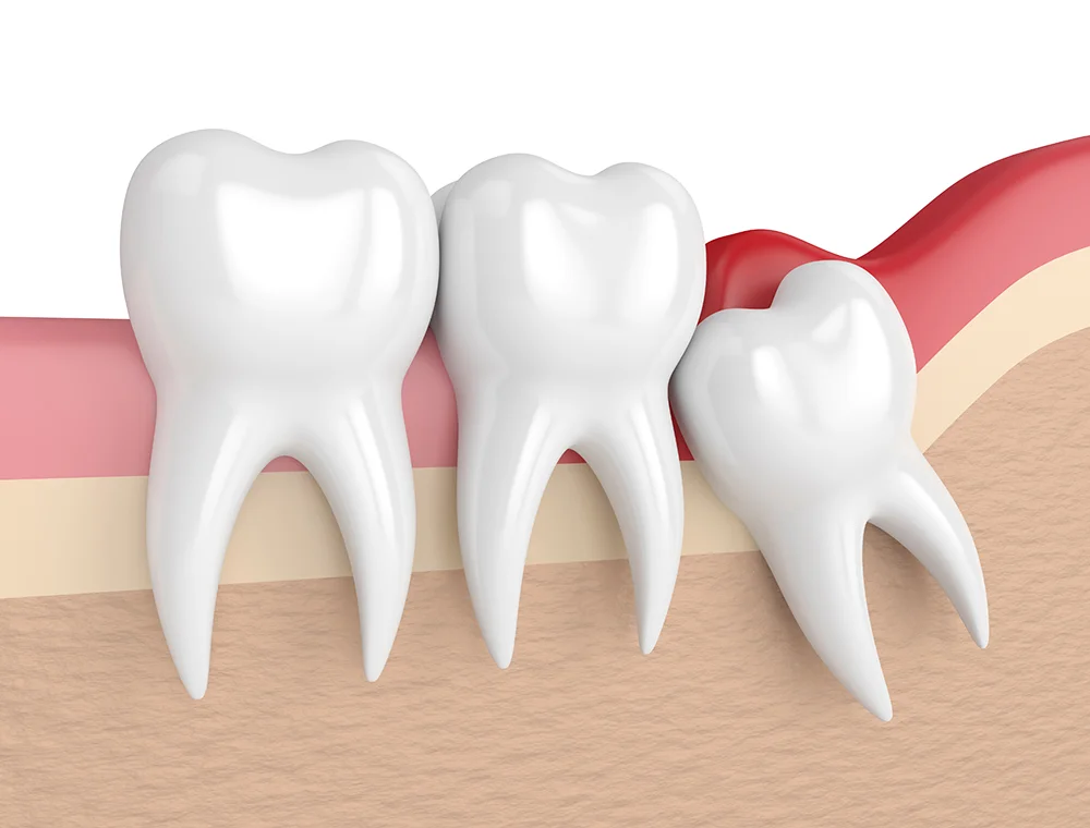 wisdom tooth surgery; When is it necessary and how is it done? - Dr. Mojtaba Jirani, specialist in root canal therapy