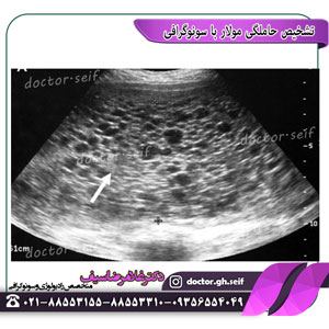 تشخیص بارداری مولار با سونوگرافی
