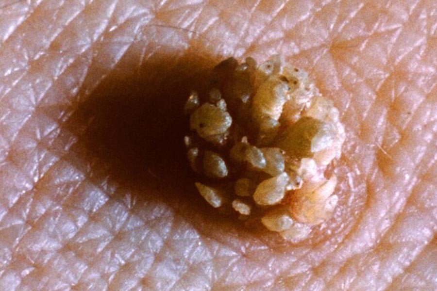 زگیل تناسلی چیست؟ - دکتر مریم غلامپور