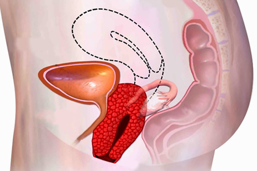 افتادگی رحم - دکتر مریم غلامپور