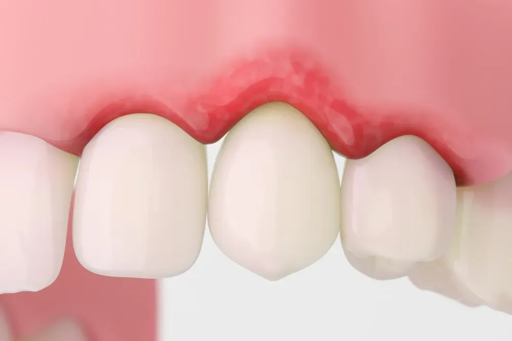 Why does gum recession happen? Causes, symptoms and treatment methods - Dr. Mojtaba Jirani, specialist in root canal therapy