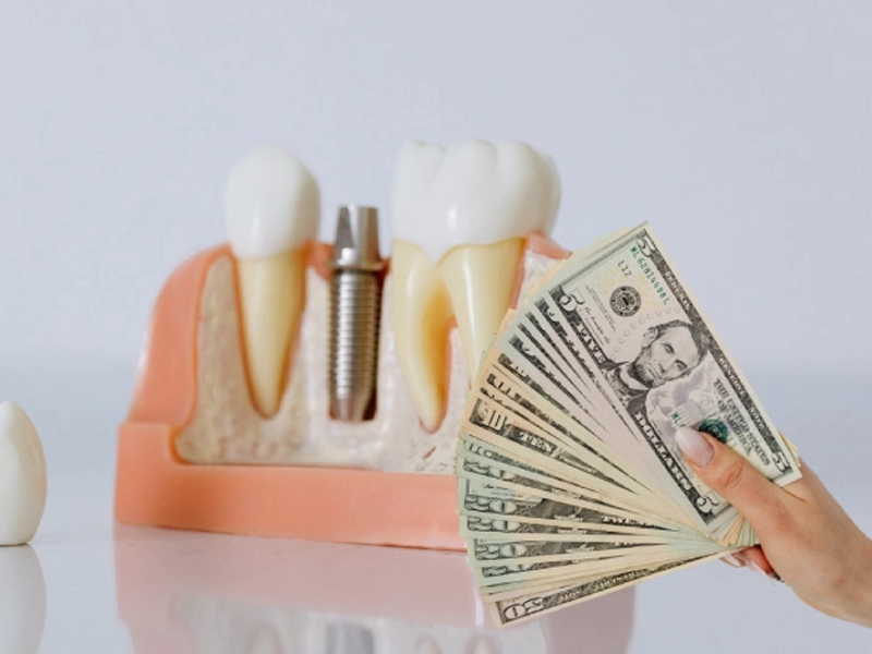 هزینه ایمپلنت دندان در کرج چقدر است؟