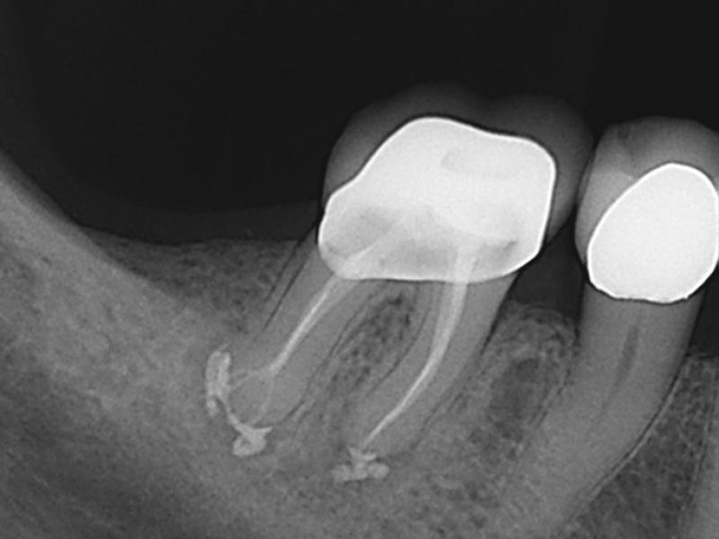 مدیریت دندان با کلسیفیکاسیون شدید کانال؛ چالش ها و رویکردهای درمانی در اندودنتیکس مدرن - دکتر مجتبی جیرانی، فوق تخصص ریشه