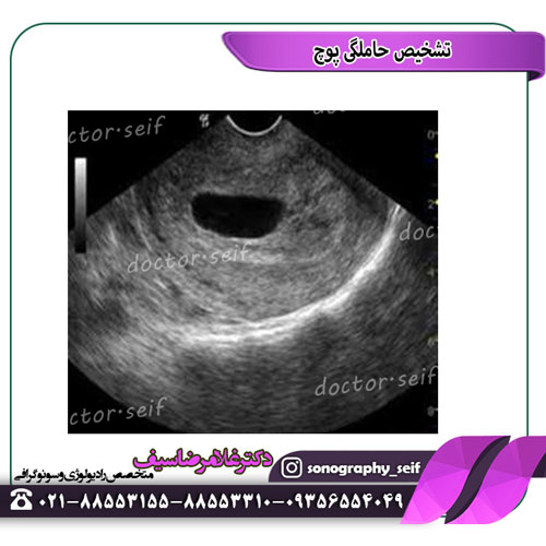 تشخیص غلط بارداری