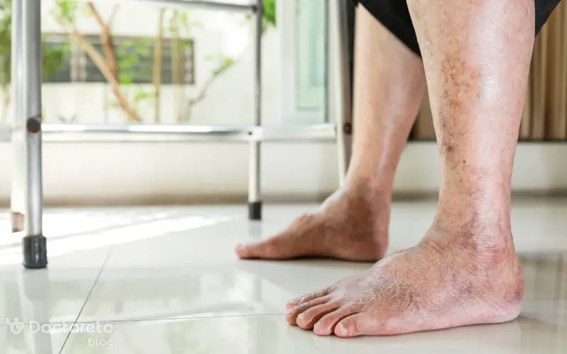 عکس زخم پای دیابتی چیست و چه علائمی دارد؟