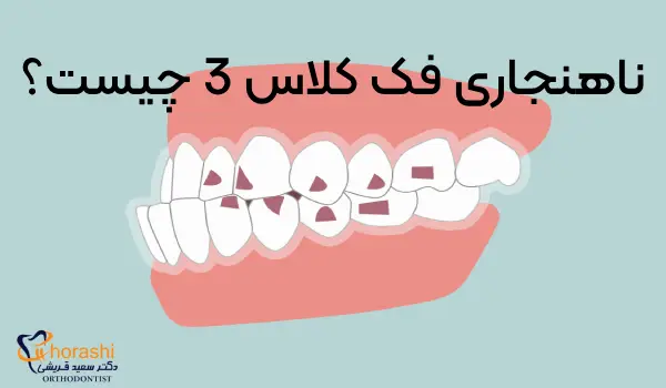 ناهنجاری فک کلاس 3 چیست و چگونه درمان می شود؟