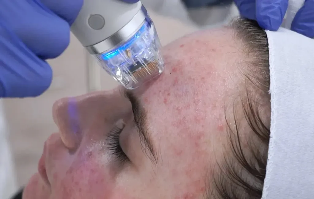 بهترین لیفت غیرتزریقی صورت و عضلات با آراف فرکشنال در بلوار فردوس؛ جایگزین برتر هایفو توسط دکتر ویدا شکیبا - کلینیک زیبایی دکتر ویدا شکیبا | زعفرانیه و صادقیه تهران